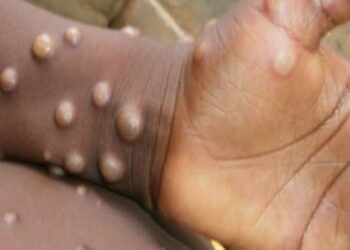 Ilustrasi cacar monyet